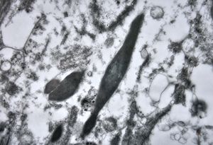 M,43y. | skin - susp. myelosis … Auer bodies M,43y. | skin - susp. myelosis … Auer bodies